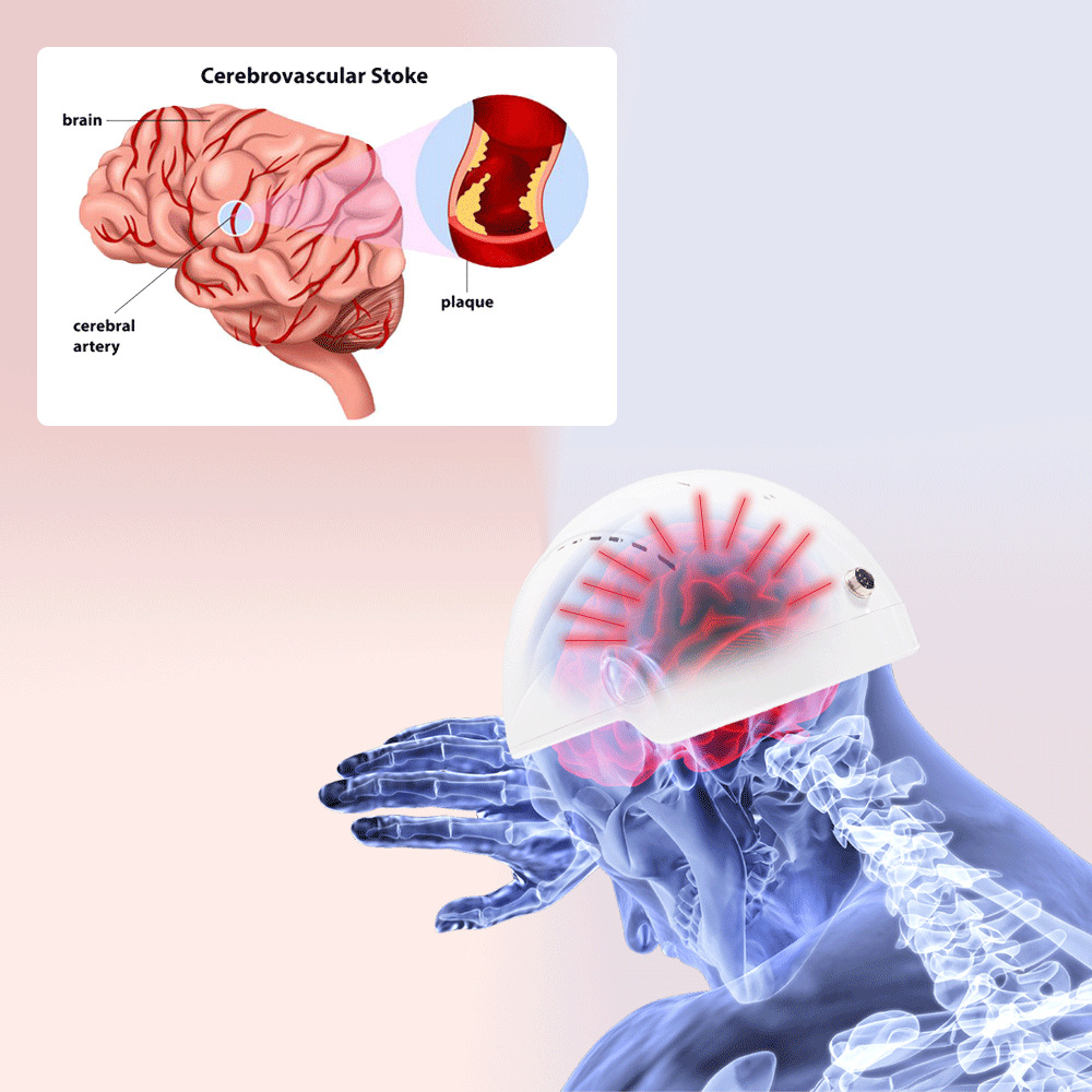 810nm Near Infrared Light Photobiomodulation Helmet Brain Therapy Euiqpment